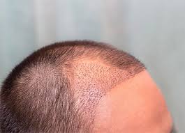 Haartransplantation Türkei Kosten: A Journey to Hair Restoration